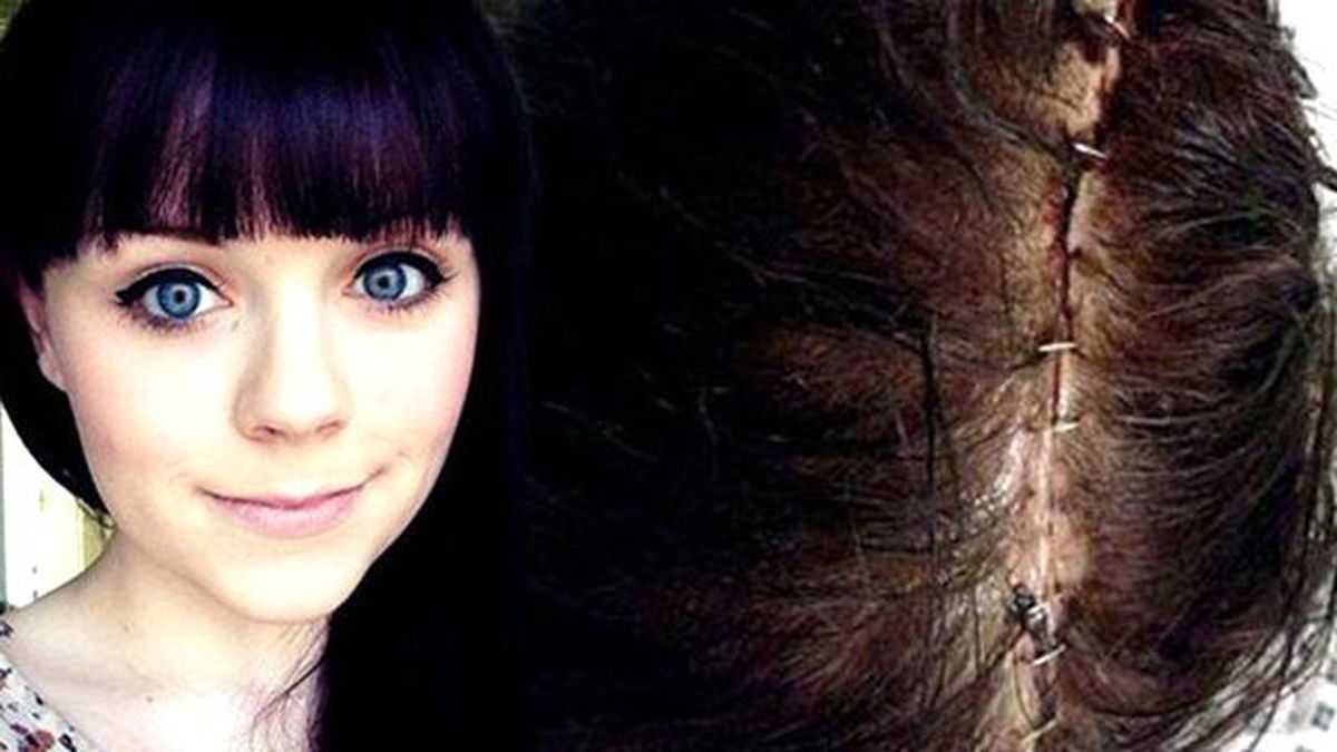 Doğum Kontrol Hapı Yüzünden Felç Geçirdi