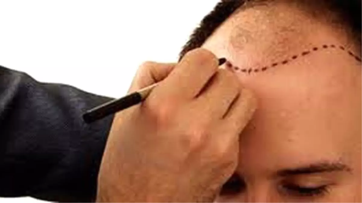 Kavurucu Sıcaklarda Saç Ekimi Yapılır (Mı ?)