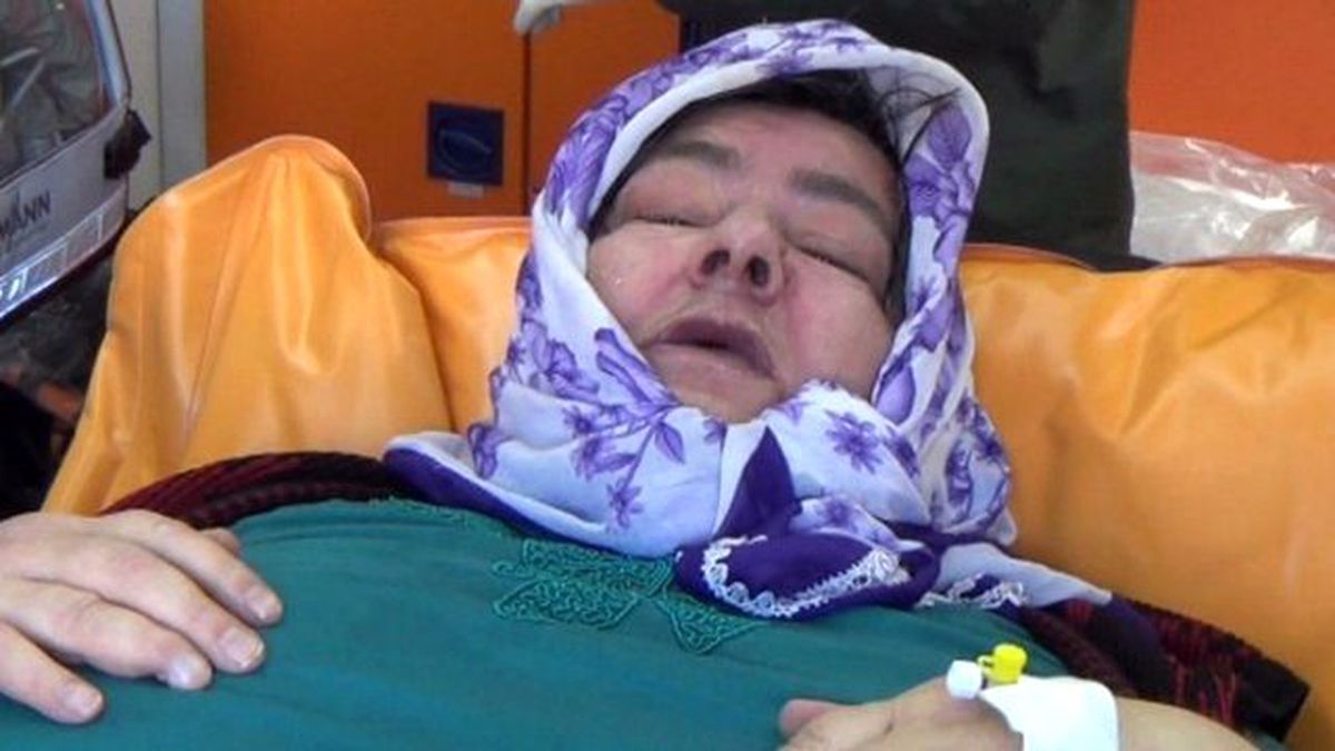 150 Kilogram Ağırlığındaki Hasta Kadını 8 Kişi Taşıyabildi