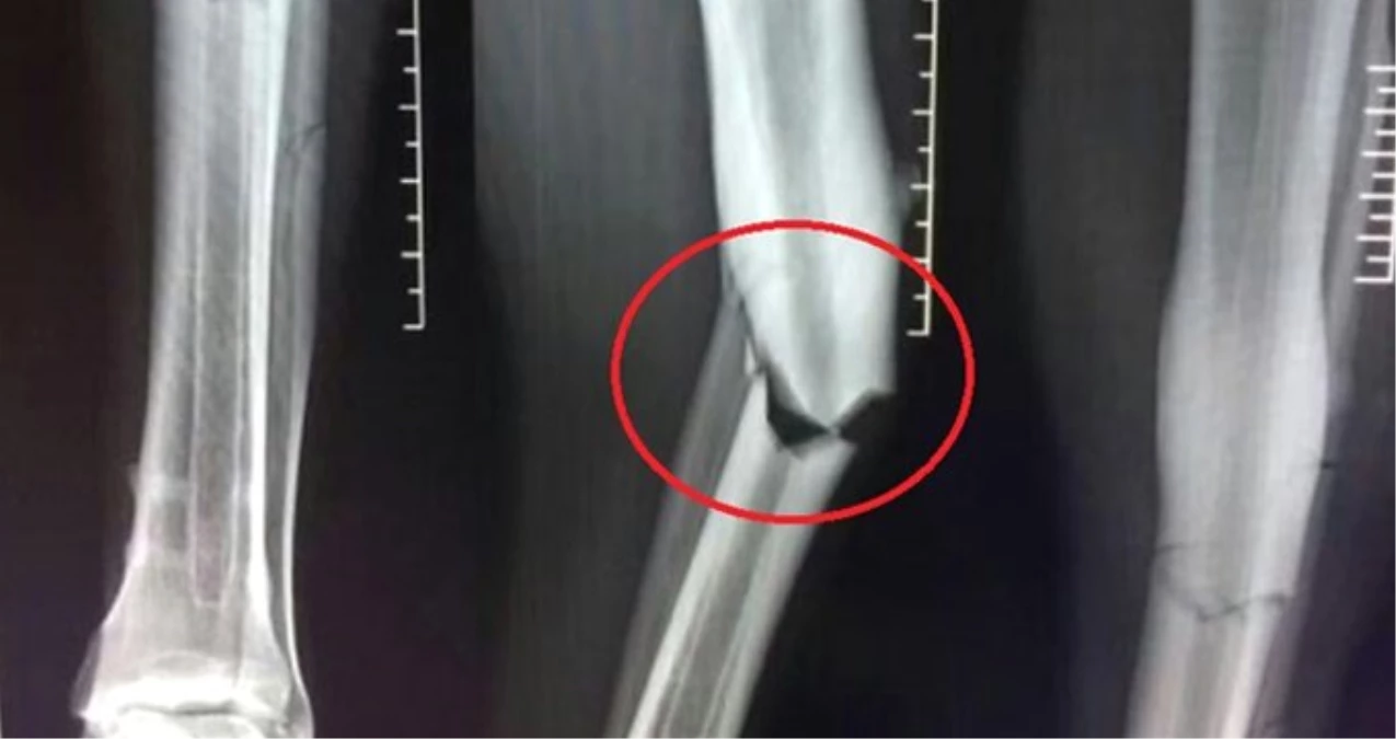 Demba Ba\'nın Bacağının X-Ray Görüntüsü Ortaya Çıktı