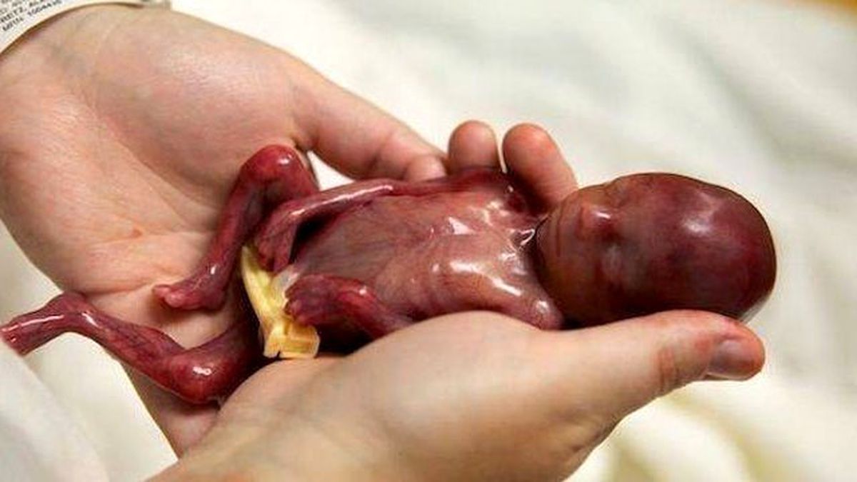 14 Haftalık Bebeğin Yaşamı Mahkeme Kararıyla Sonlandırıldı