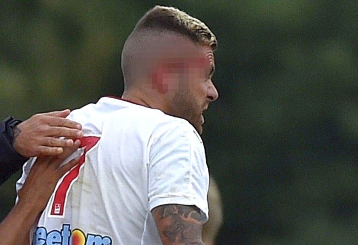Jeremy Menez\'in Sağ Kulağı Koptu