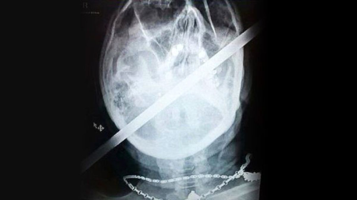 Deneyimli Bisikletçinin Kafasına Demir Çubuk Saplandı