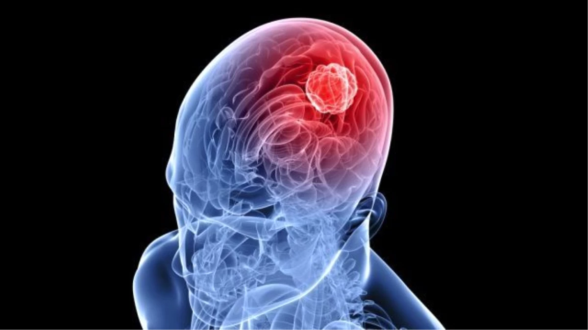 Beyin Tümörlerinde umut veren yeni tedavi açıklandı