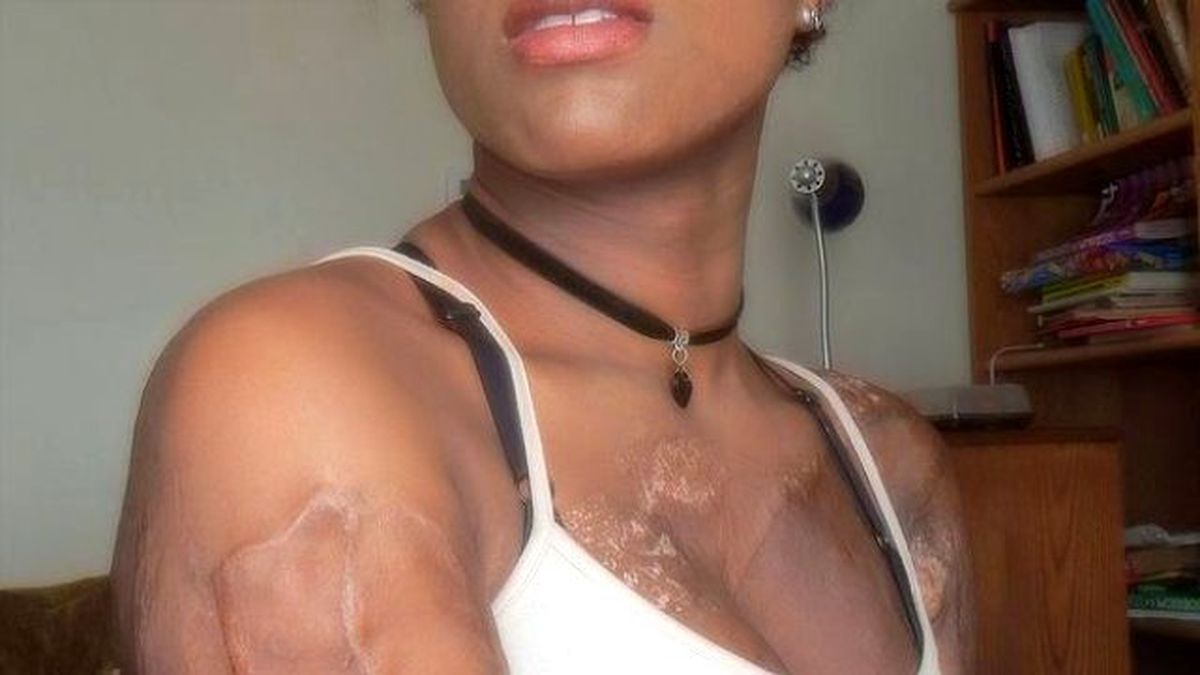 Vücudu Kadavra Derileriyle Kaplandı