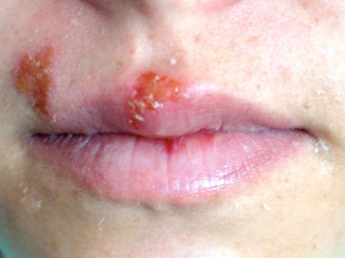 Dermatoloji Uzmanı Dr. Ertek: "Uçuğa El Sürmeyin"