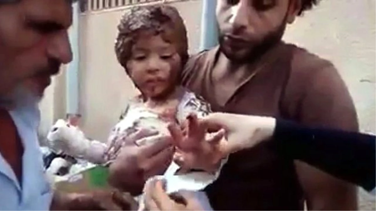 Atılan Bombanın Etkisiyle Yanan Suriyeli Çocuğun Görüntüleri Yürek Dağladı