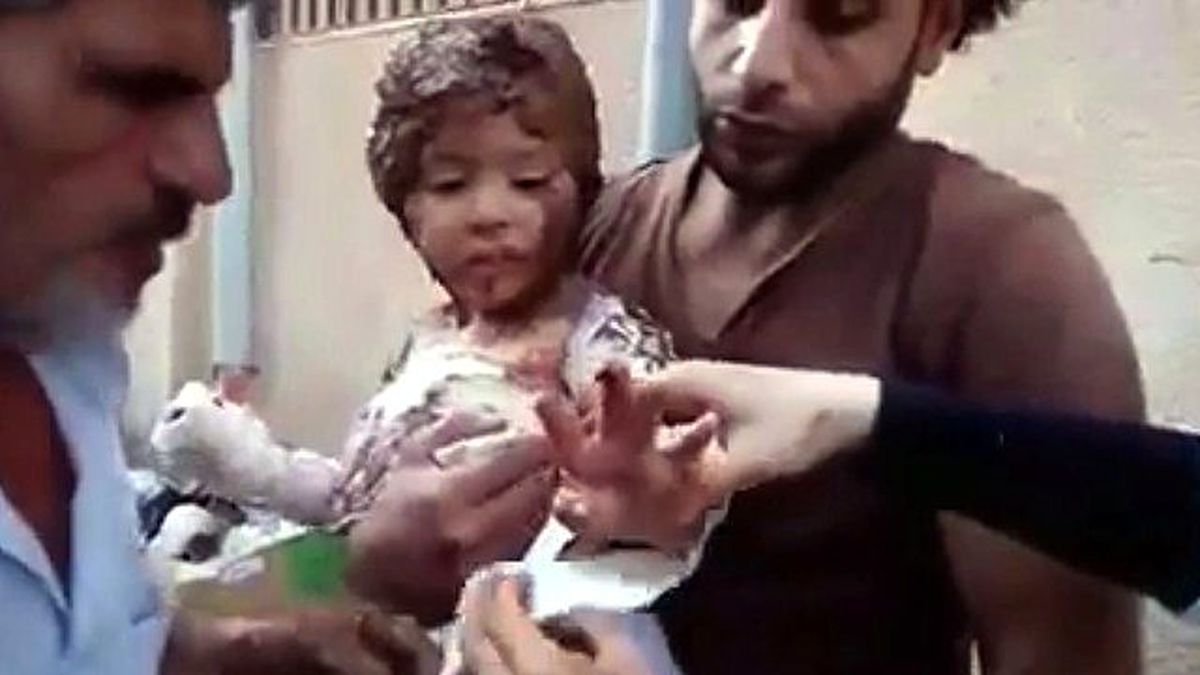 Atılan Bombanın Etkisiyle Yanan Suriyeli Çocuğun Görüntüleri Yürek Dağladı