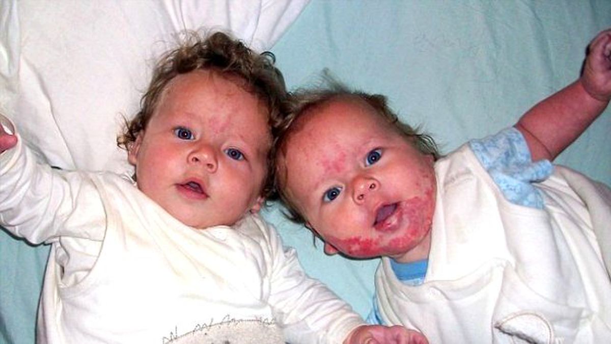 Doğum Lekesi Nefes Borusuna Kadar Yayılınca Boğulma Tehlikesi Geçirdi