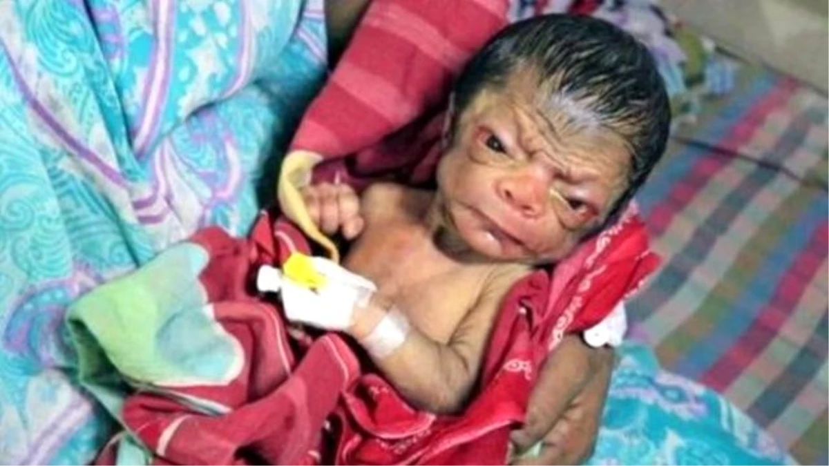 4 Milyarda Bir Görülen Hastalıkla Dünyaya Gelen Patro Bebek 80 Yaşında Gibi Görünüyor