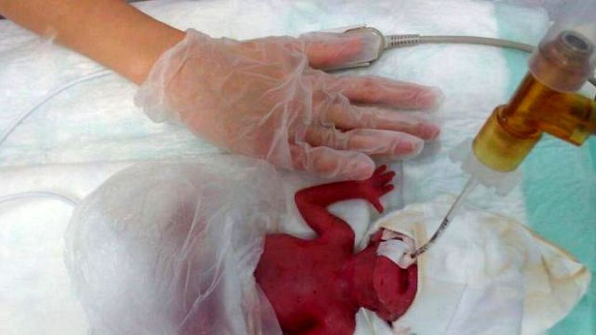 Görüntülü Haber) 380 Gramlık Azra Bebek Yaşama Tutundu