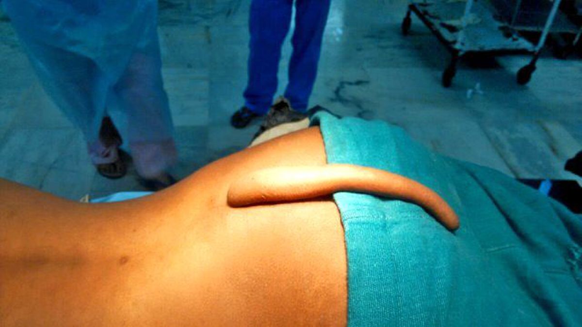 18 Yaşındaki Gencin Kuyruğu Ameliyatla Alındı