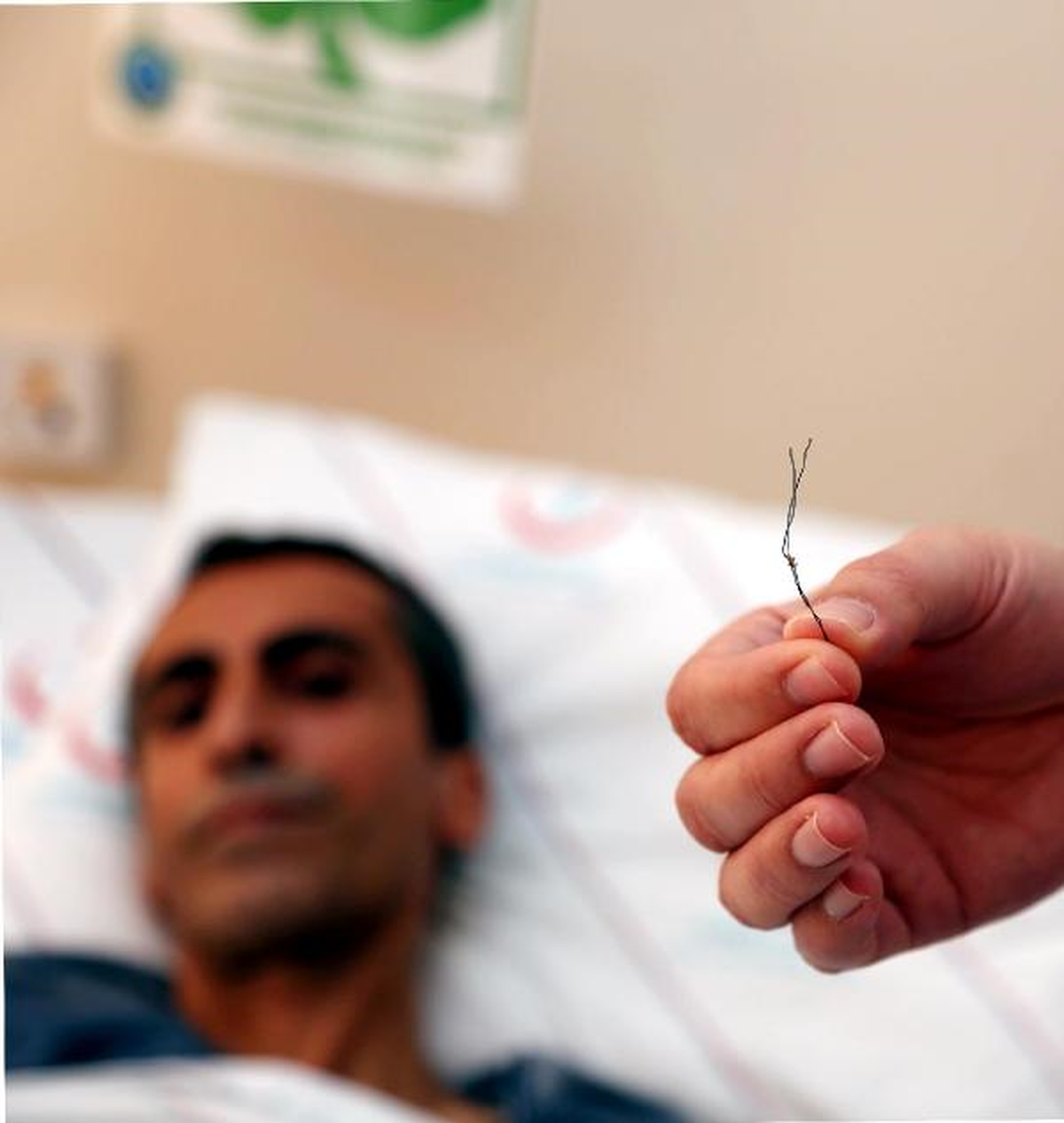 Bağırsağından 10 Santimlik Tel Çıktı