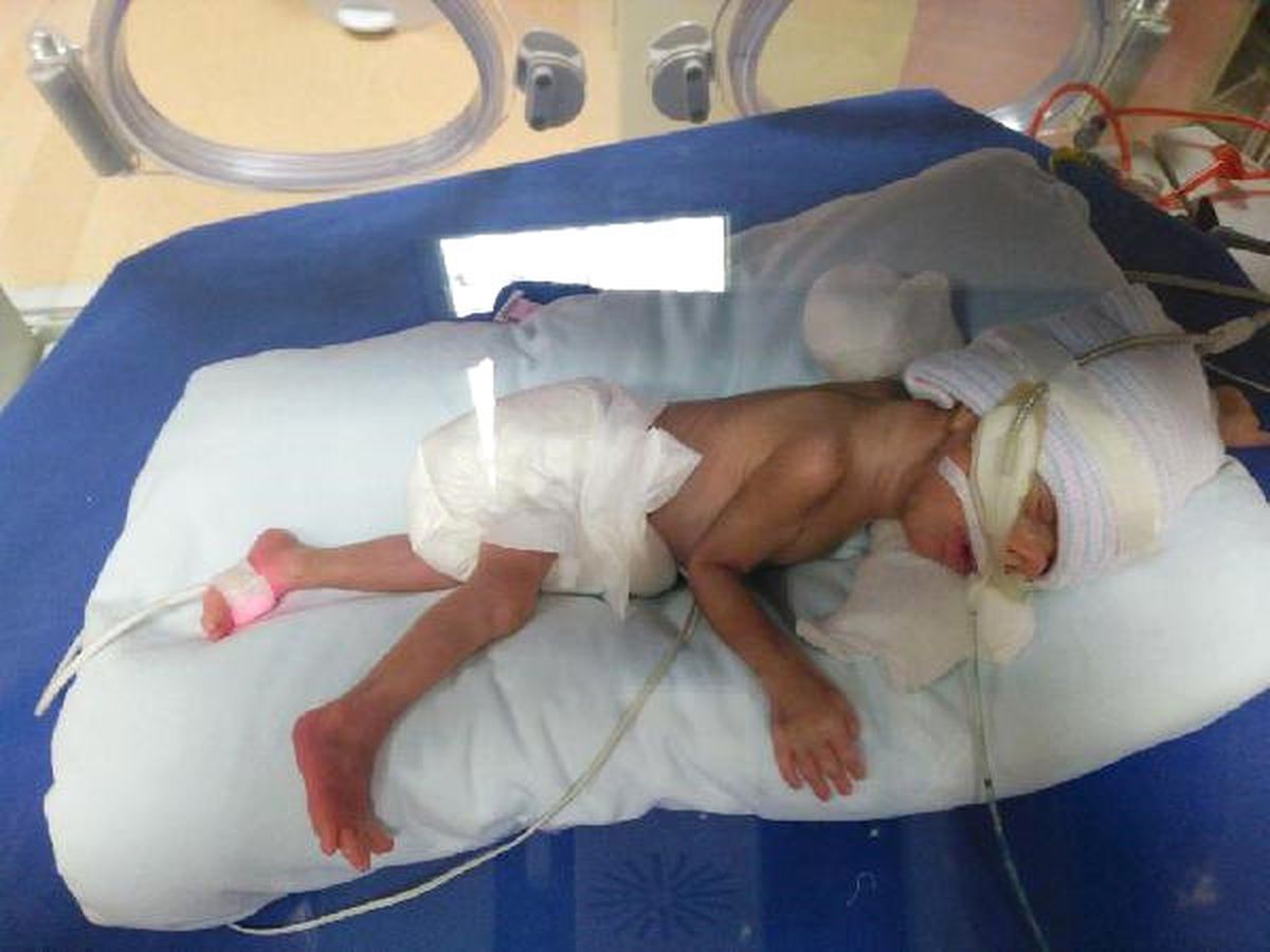Özlem Bebek 10 Ayda 850 Gramdan 8 Kilo 700 Grama Ulaştı