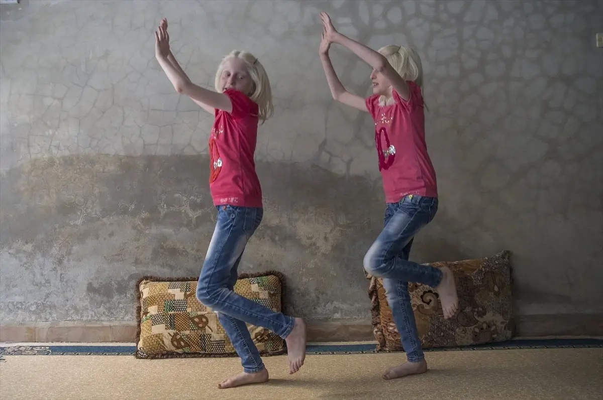 Suriyeli Albino Hastası İkizler Ailelerinin Neşe Kaynağı