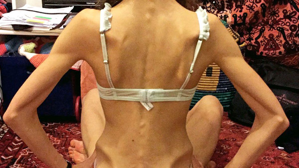 Anoreksiya Hastası Kız 25 Kiloya Kadar Düştü