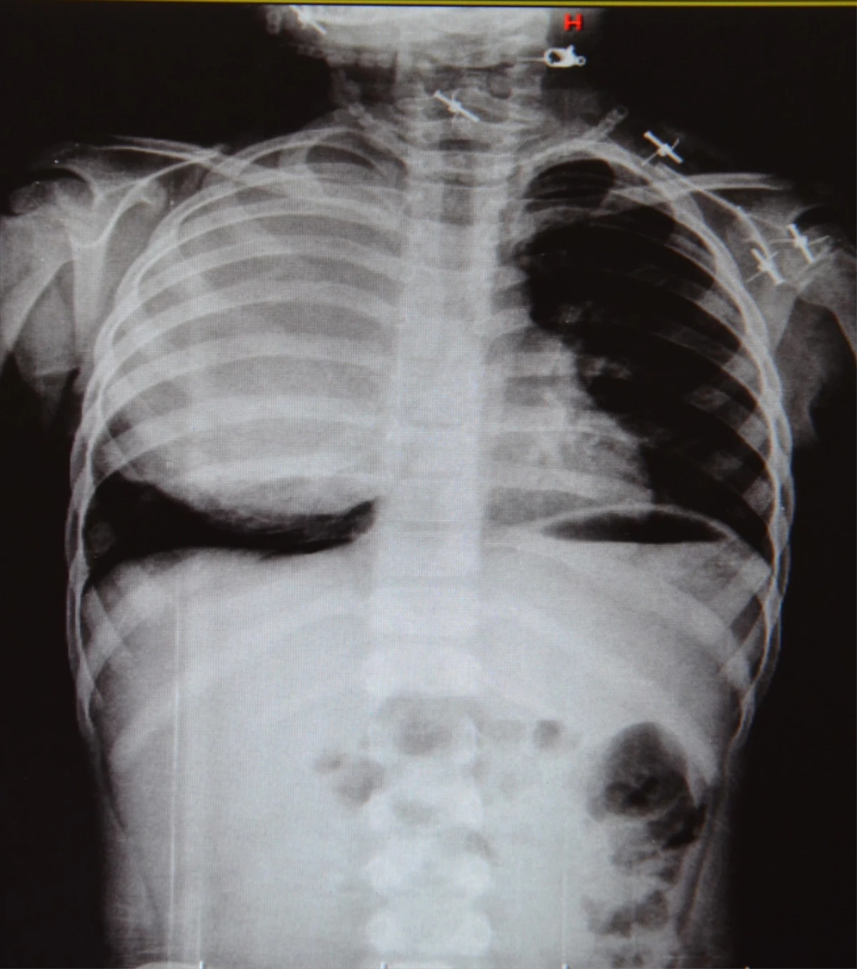 Çocuğun Akciğerinden 15 Santimetre Çapında Kist Çıkarıldı
