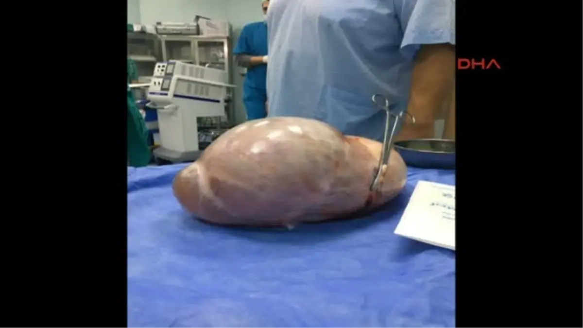 Kocaeli Karnından 5 Kilo 650 Gram Kist Çıktı