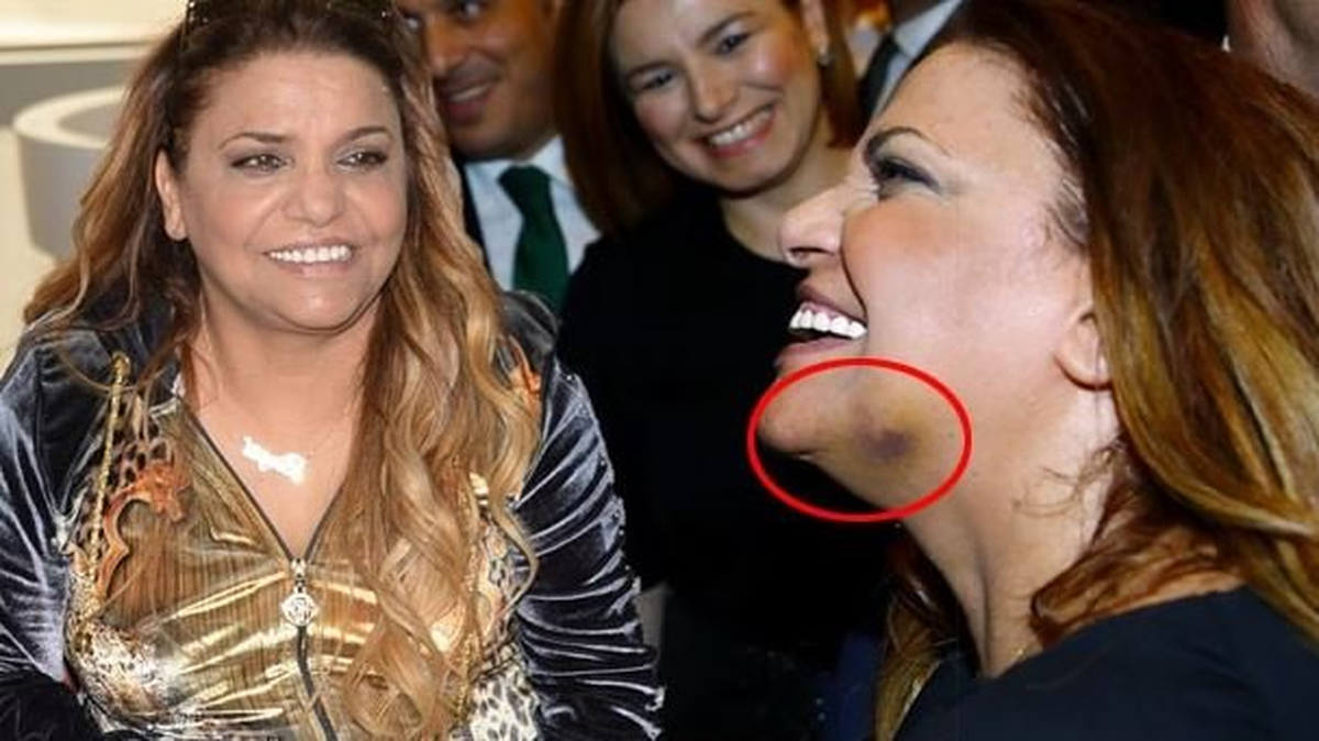 Kibariye'nin Yüzündeki Morluğun Nedeni Belli Oldu