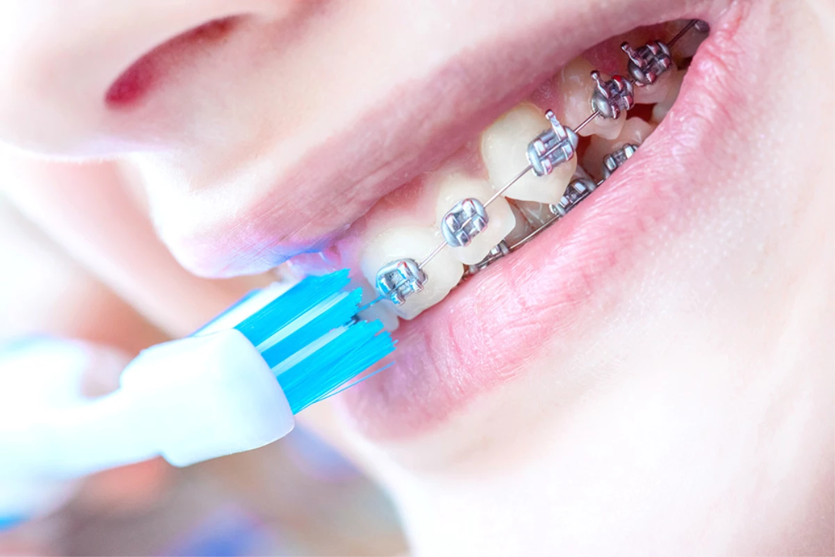 Diş teli tedavisinde dikkat edilmesi gereken 11 nokta