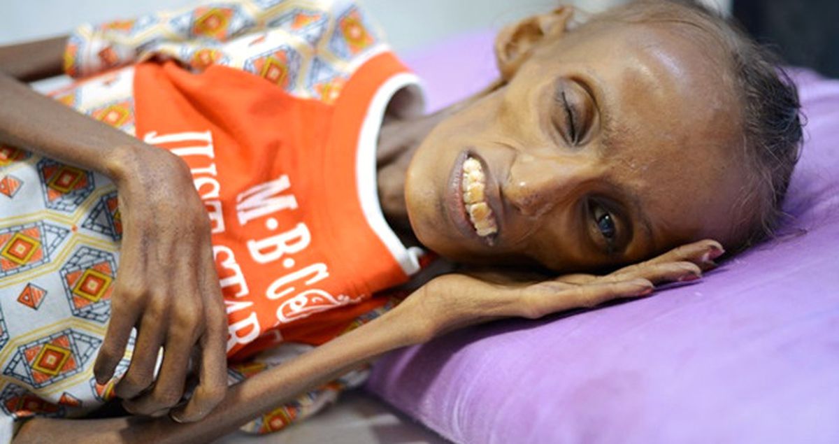 Savaş, Yemenlileri Kıtlığa Sürükledi! 10 Milyon Çocuk Acil Yardım Bekliyor