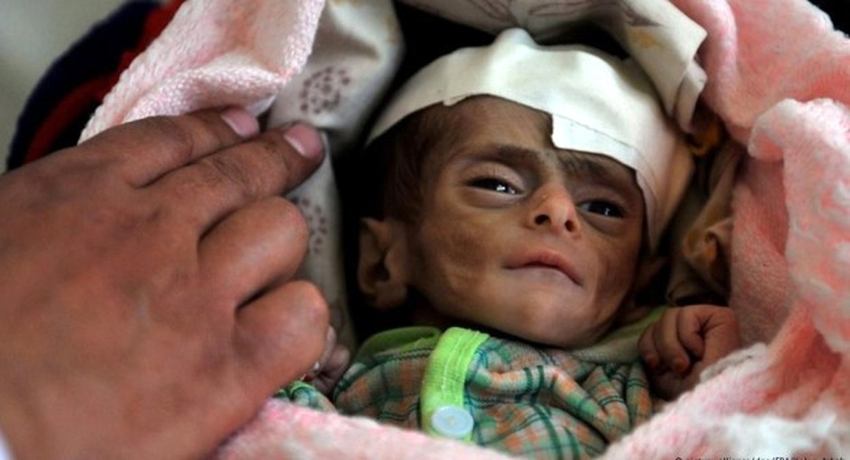 Yemen\'de Çocuklardaki "Yetersiz Beslenme" Sorunu