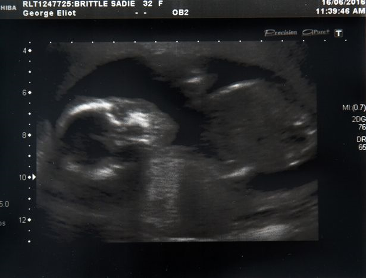 Anne Karnındaki Gizli Bebek 3 Ay Sonra Ortaya Çıktı