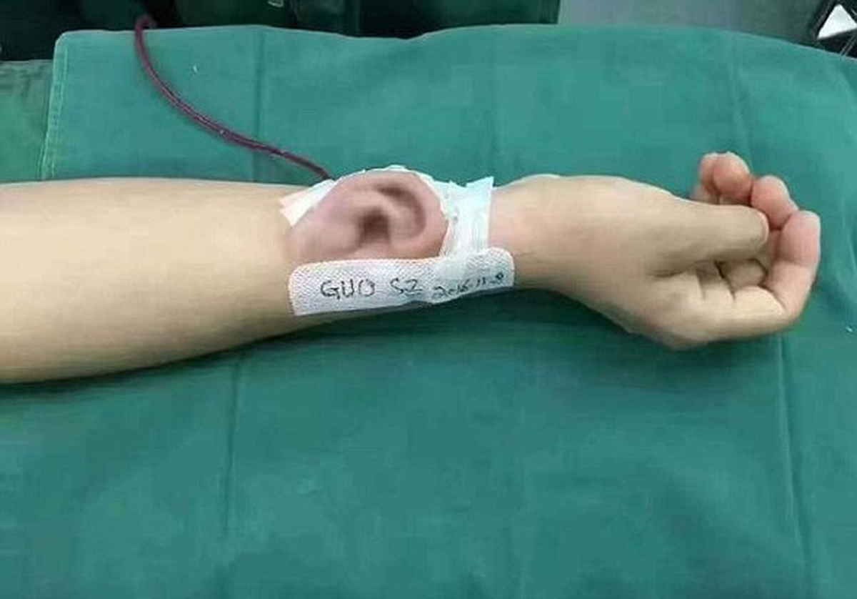 Koluna Nakledilen 'Yapay Kulak' Sayesinde Yeniden Duyabilecek!