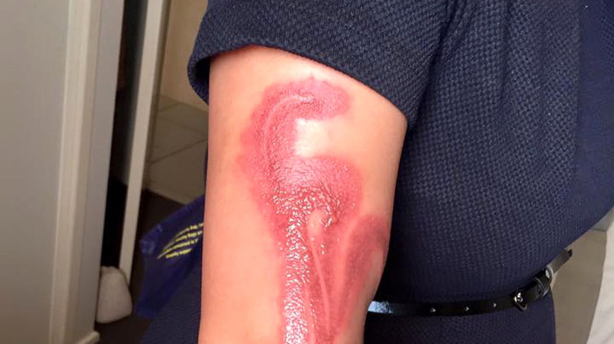 iPhone 7, Uyuyakalan Hamile Kadının Kolunu Mahvetti