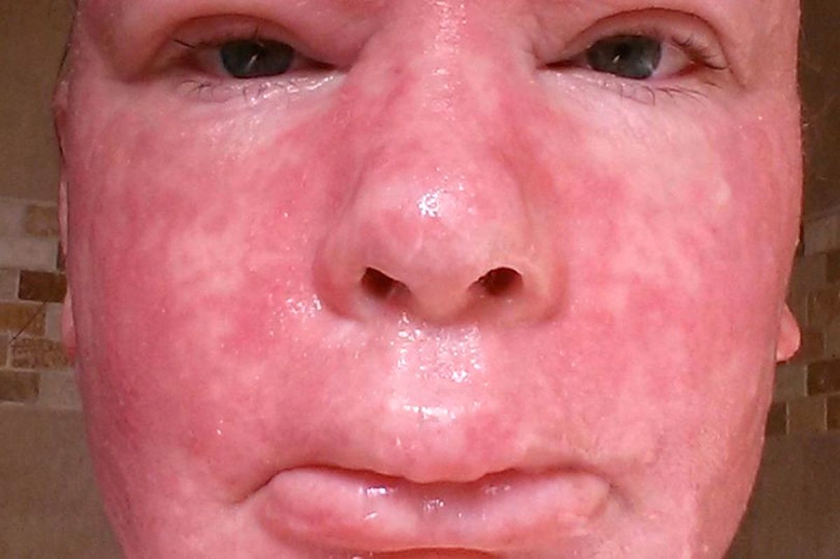 Egzama Hastası Kadın Steroidleri Bırakınca Pürüzsüz Bir Cilde Kavuştu