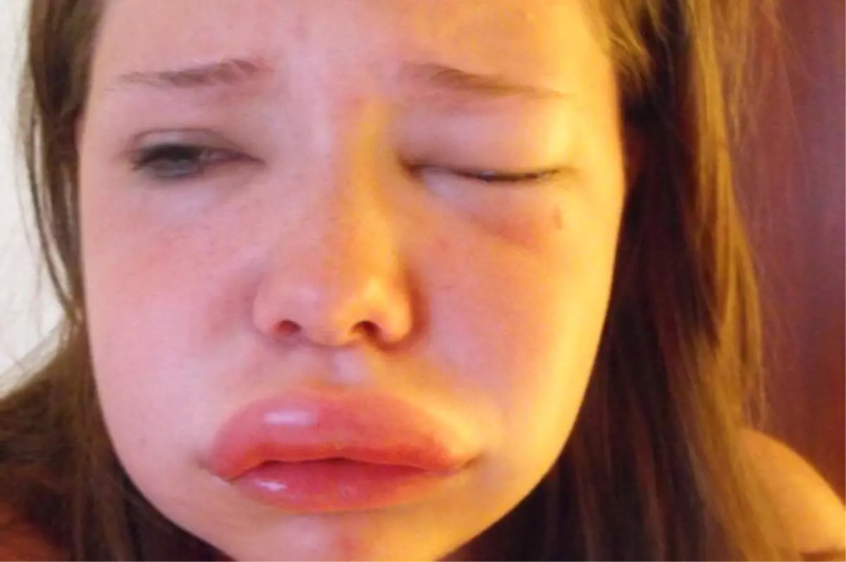 20 Yaşındaki Genç Kız Hayatını Tehdit Eden Hastalığa Meydan Okuyor