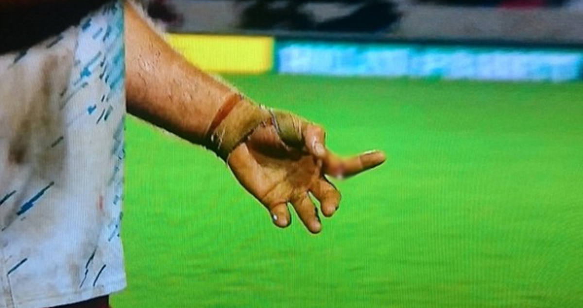 Rugby Maçında Oyuncunun Parmağı Koptu