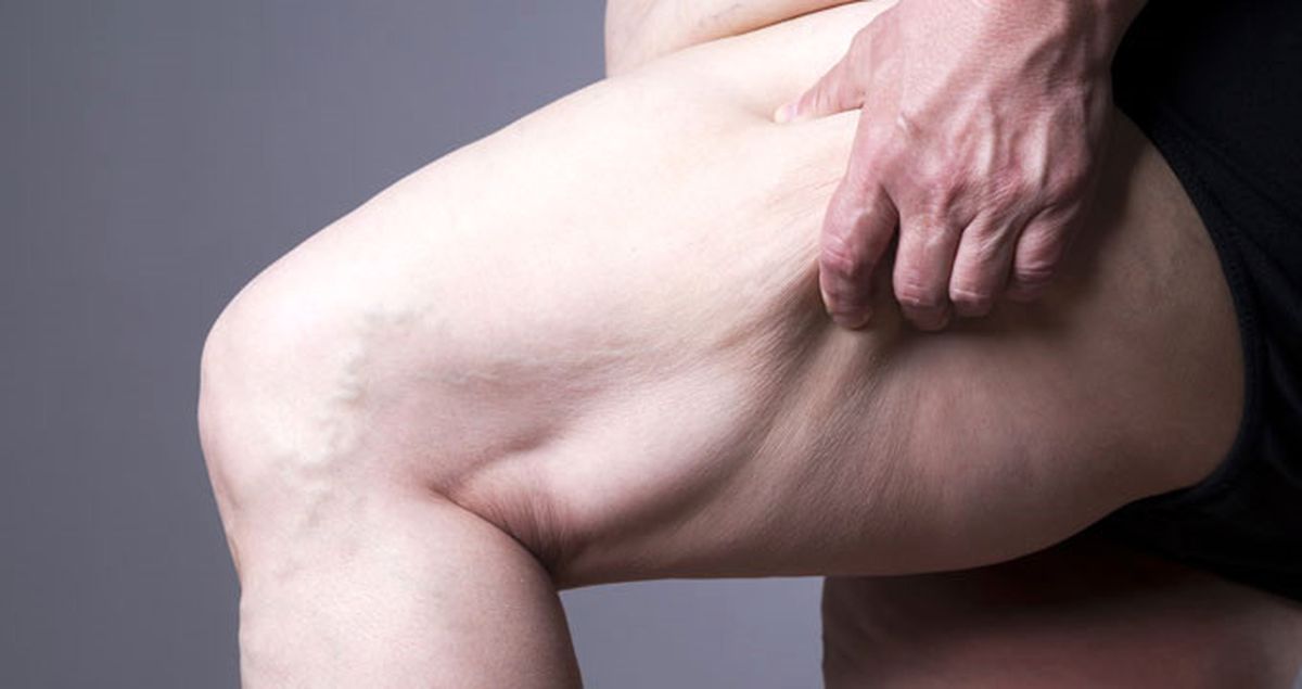 2025'te Her 5 Kişiden 1'i Obez Olacak!