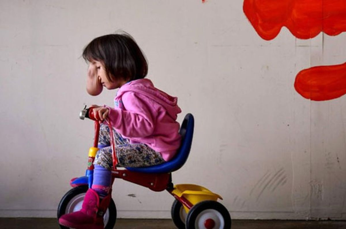 Beyin Anomalisi ile Doğan Angel Artık Gülümseyebiliyor!