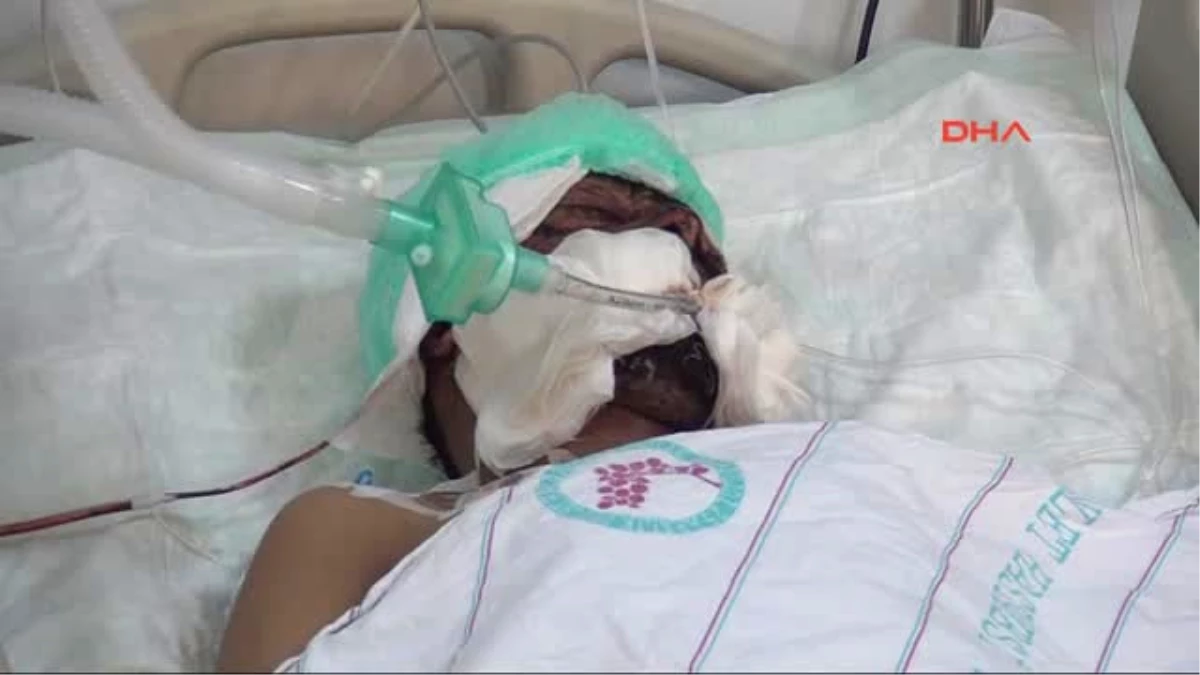 Gaziantep - Patlamada Kafasına Saplanan Taş Ameliyatla Çıkartıldı