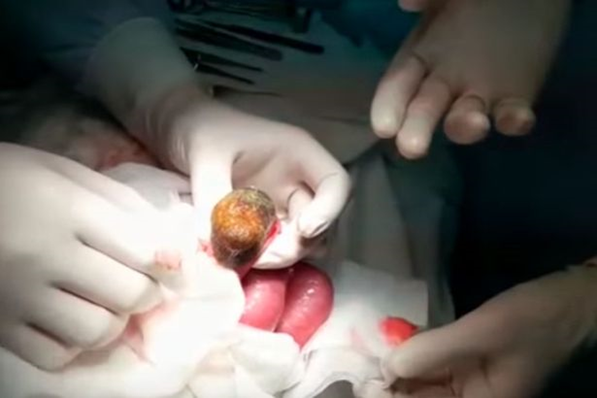 Karnı Ağrıyan Kızın Bağırsağından Saç Çıktı