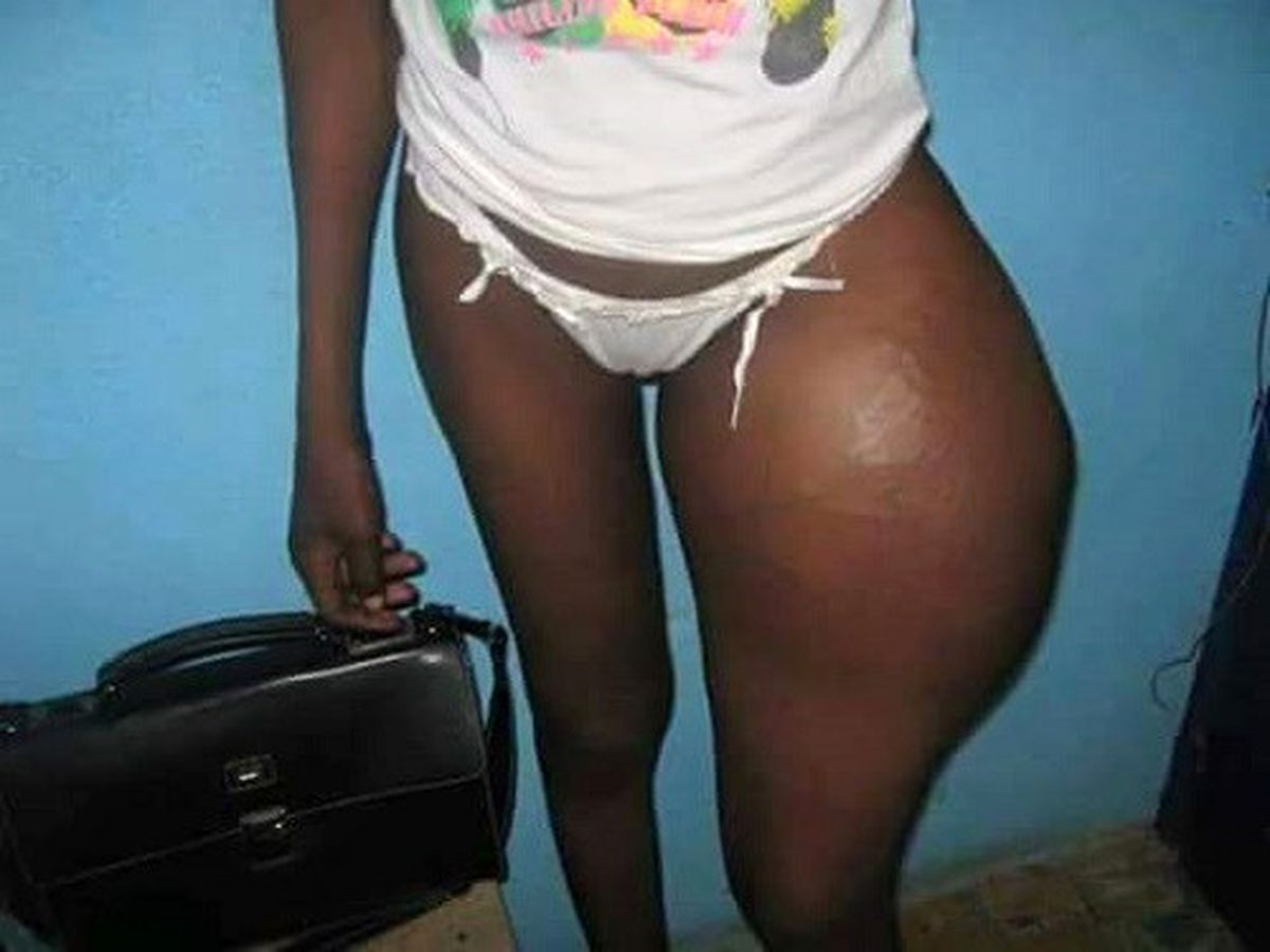 Kim Kardashian Gibi Kalçalara Sahip Olmak İsteyen Kadın Bin Pişman Oldu