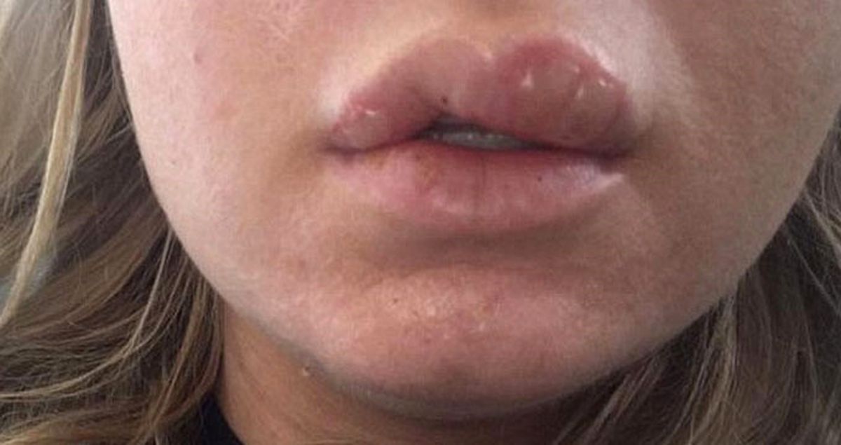 Taklit Ruj Kullanan Kadının Dudağı Yandı