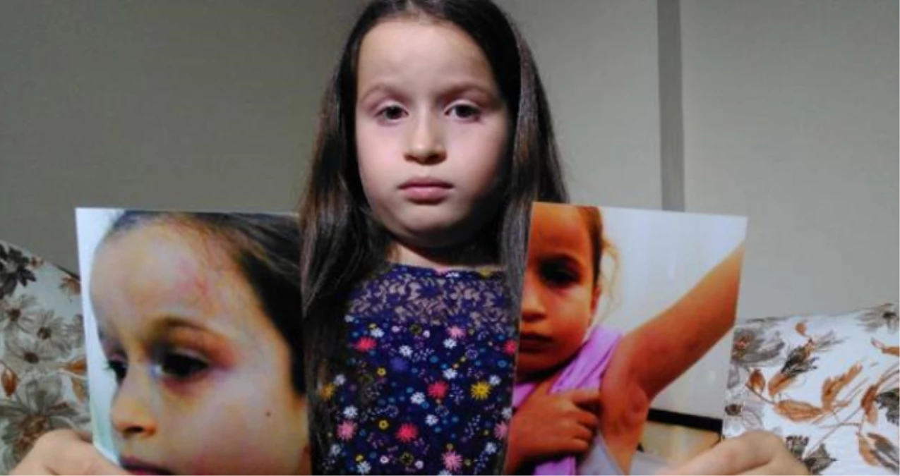 Dişçiye Giden 8 Yaşındaki Kız, Ağzını Açmadığı İçin Doktor Tarafından Darp Edildi