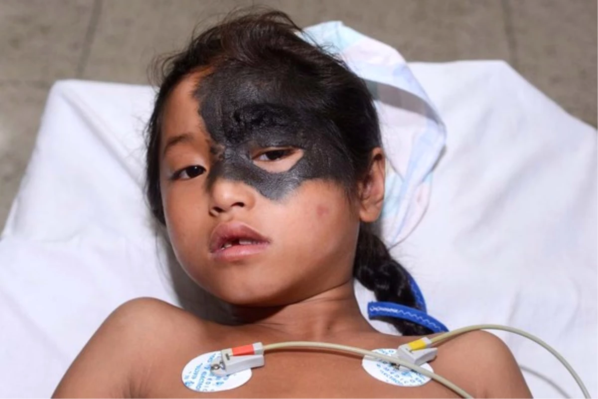 Nepalli Küçük Kızın Yüzünde Saç Çıkıyor