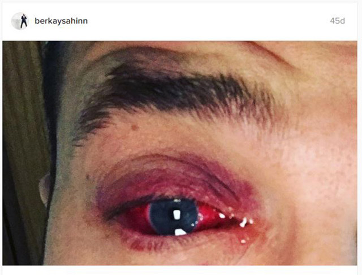 Berkay sağlık problemi "Göz Sağlığının önemini" gündeme getirdi