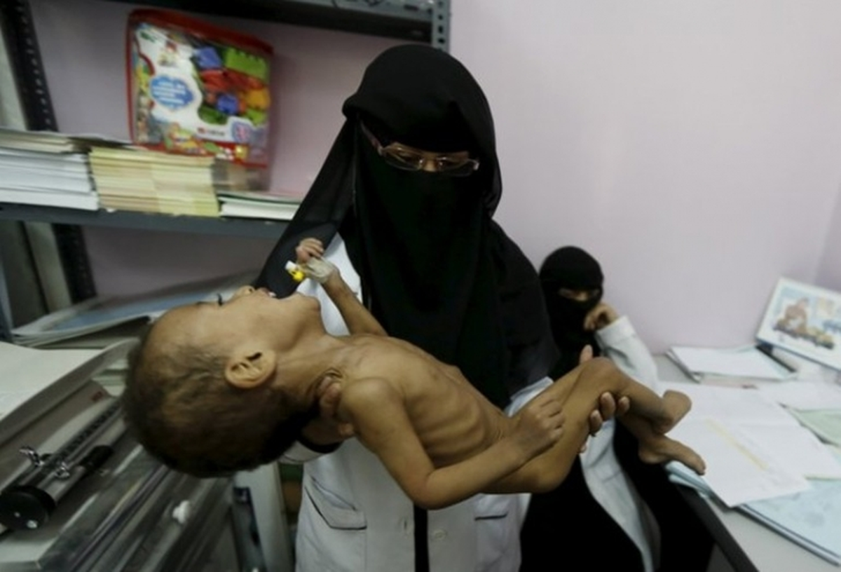 Yemen\'de Çocuklar Yetersiz Besleniyor