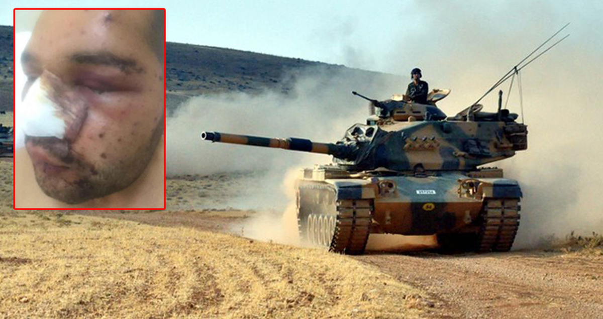 El Bab\'da Yaralanan Uzman Onbaşı: Bir Gözü Kaybettiysek Diğeri Bize Yeter