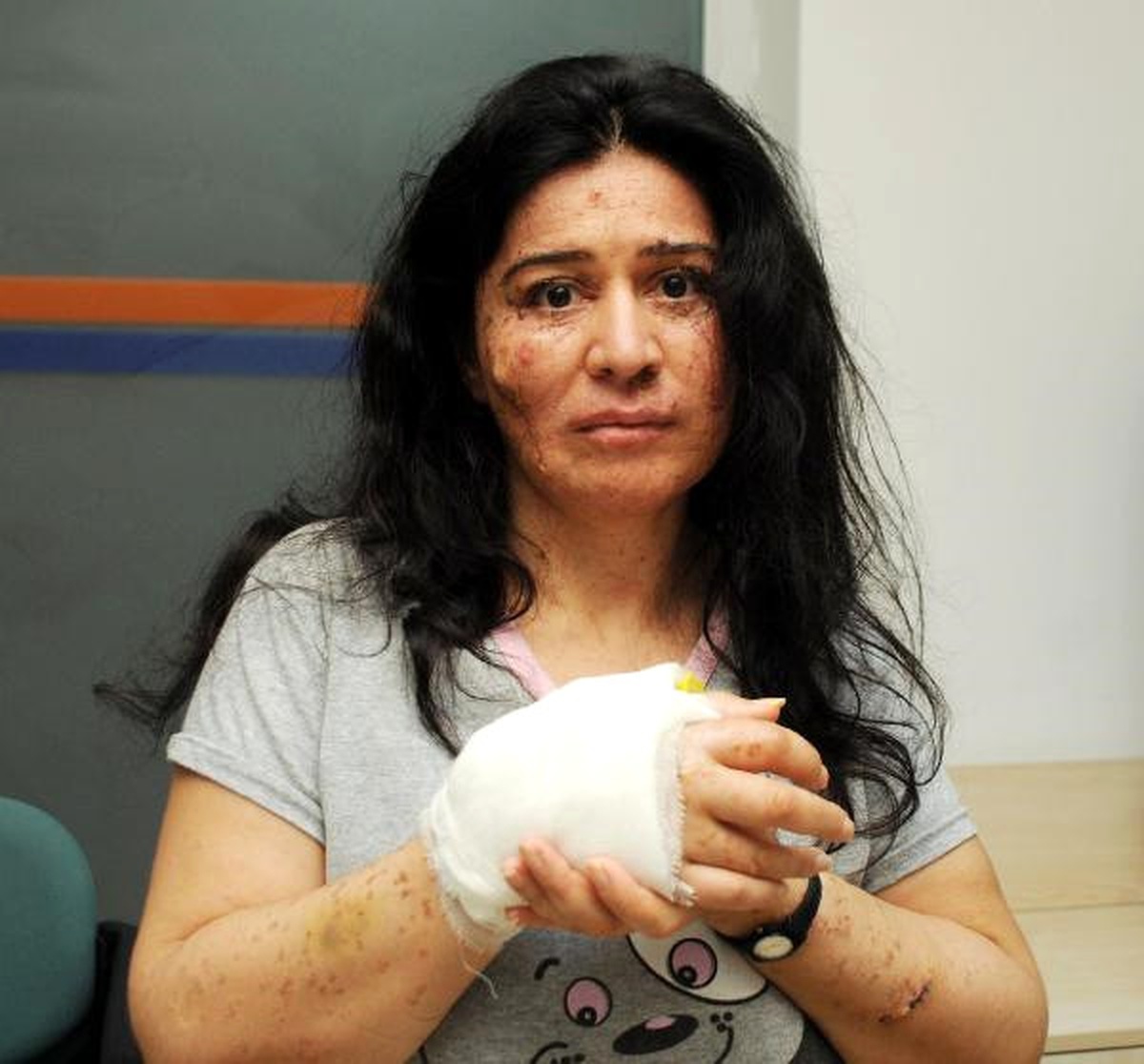 Deri Hastası Annenin Feryadı: Kızım İçin Yaşamak İstiyorum