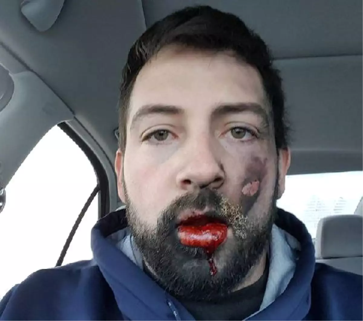 Elektronik Sigara Suratında Patladı, Yedi Dişini Kaybetti