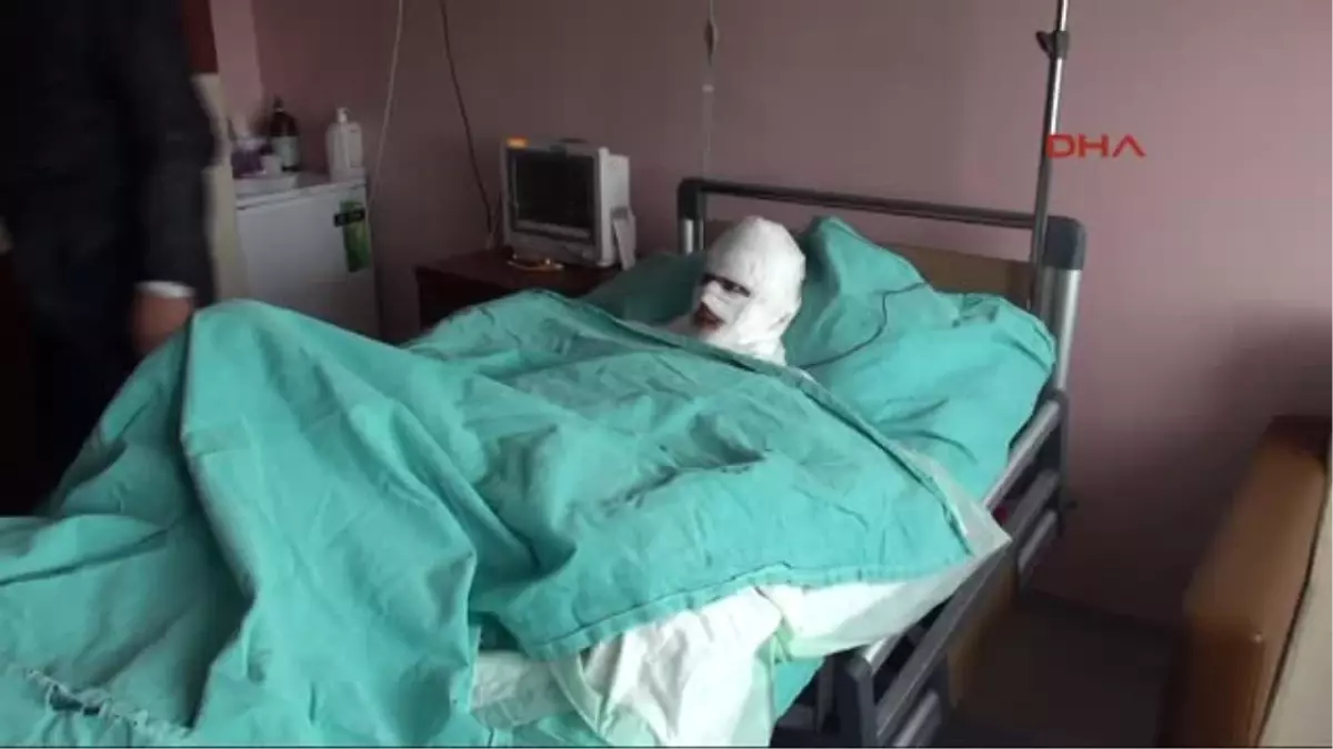 Sivas Suriye\'de Vücudu Yanan Aişe, Sivas\'ta Tedavi Görüyor