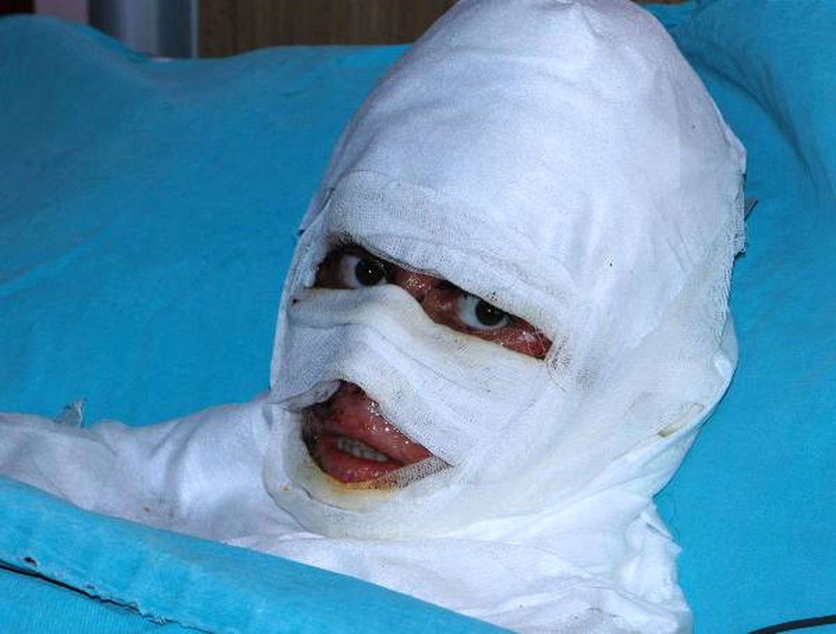 Suriye\'de Vücudu Yanan Aişe, Sivas\'ta Tedavi Görüyor