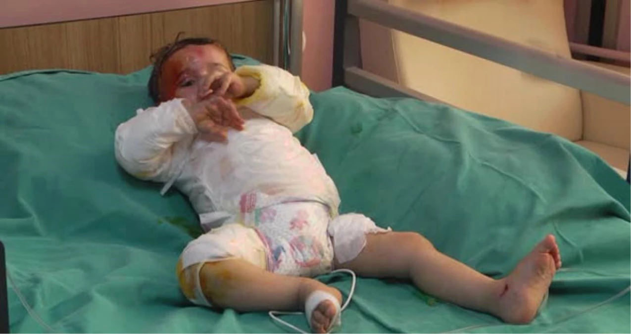 Üzerine Tencere Devrilen Suriyeli Bebek, Türk Doktorların Çabasıyla İyileşti