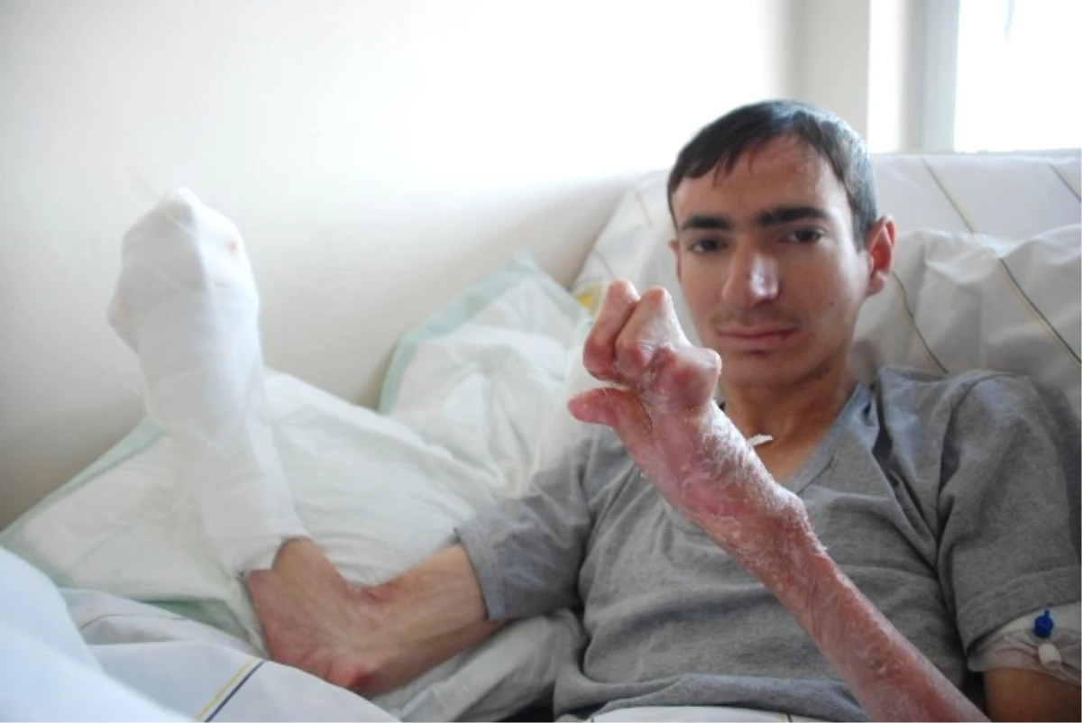 Kelebek Hastası Genç, Kapanan Ellerine 5 Yıl Sonra Kavuştu