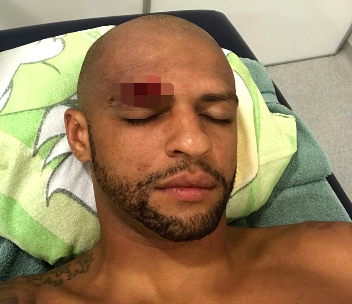Melo\'nun Kaşı Açıldı